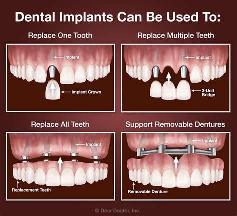 No Batteries Here: New Implants Can C